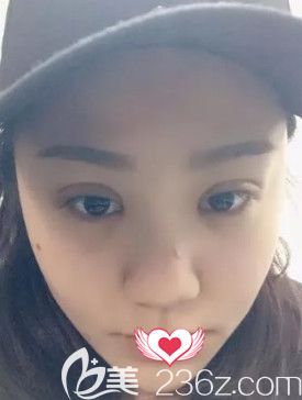 在石家庄蓝山做眼综合术后7天进行拆线 在石家庄蓝山做眼综合术后7天进行拆线