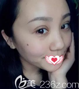 王兴奎院长做眼综合术后15天眼睛消肿 王兴奎院长做眼综合术后15天眼睛消肿