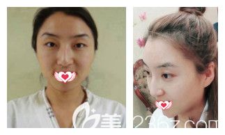 秦皇岛巧致双眼皮案例 秦皇岛巧致双眼皮案例