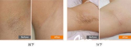 巧致整形医院脱腋毛案例 巧致整形医院脱腋毛案例