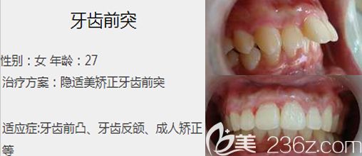 程玲隐形矫正矫正案例