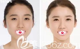 秦皇岛巧致注射瘦脸案例 秦皇岛巧致注射瘦脸案例