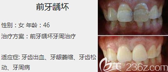 郑州唯美口腔艾西川医生前牙龋坏治疗案例