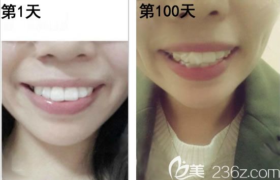 戴牙套第1天和第100天的照片