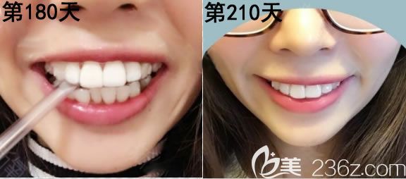 第6个月和第7个月的牙齿变化