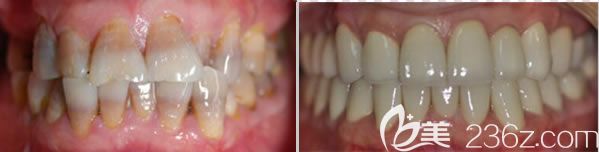 四环素牙治疗后的效果图