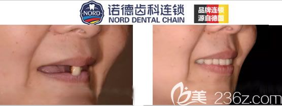 深圳诺德口腔鲍立峰全口牙种植案例图