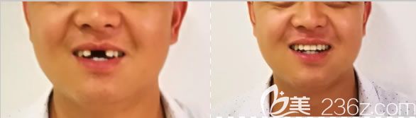 深圳诺德齿科朱俊前门牙缺失2颗种植案例图 深圳诺德齿科朱俊前门牙缺失2颗种植案例图