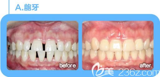 深圳诺德文梁医生成人龅牙和牙齿稀疏矫正案例对比图