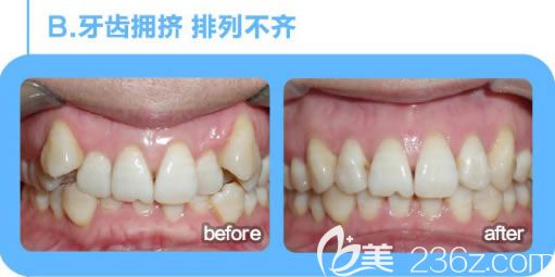 文梁医生牙齿拥挤和虎牙矫正后的对比效果 文梁医生牙齿拥挤和虎牙矫正后的对比效果