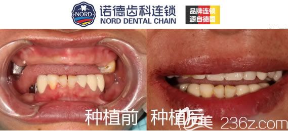 深圳诺德齿科周森半口种植牙案例图 深圳诺德齿科周森半口种植牙案例图