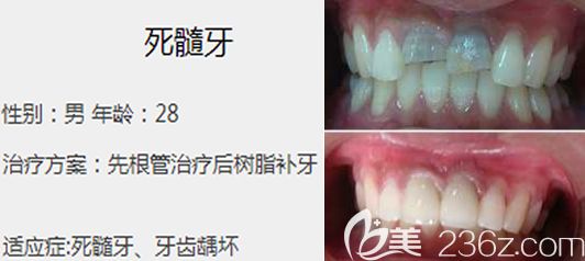 郑州唯美口腔罗柏柯牙齿修复案例