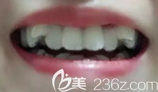 我在<!--<i data=20240703-sp></i>-->做牙齿矫正前的照片 我在<!--<i data=20240703-sp></i>-->做牙齿矫正前的照片