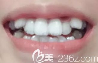 我在<!--<i data=20240703-sp></i>-->做隐形矫正第3个月 我在<!--<i data=20240703-sp></i>-->做隐形矫正第3个月