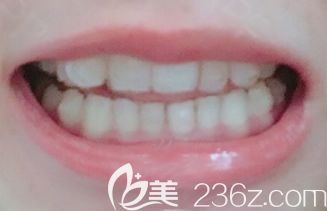 我在<!--<i data=20240703-sp></i>-->做牙齿矫正第12个月 我在<!--<i data=20240703-sp></i>-->做牙齿矫正第12个月