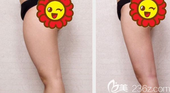 赤峰丽都韩建医生大腿吸脂前后效果对比案例