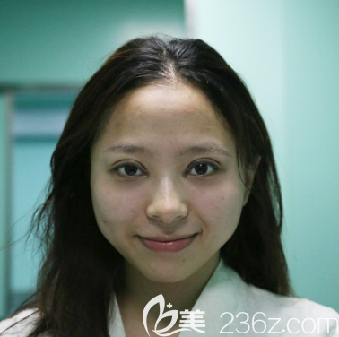 广州紫馨李政祐双眼皮修复案例术后即刻效果