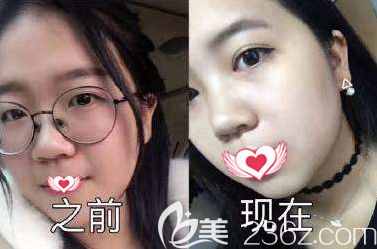 王兴奎院长做双眼皮案例 王兴奎院长做双眼皮案例