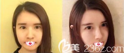 医生做鼻综合案例