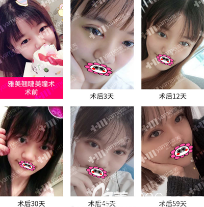 湘潭雅美整形怎么样,看双眼皮案例分享 湘潭雅美整形怎么样,看双眼皮案例分享