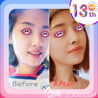 湘潭雅美整形医院隆鼻效果图 湘潭雅美整形医院隆鼻效果图