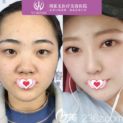 玥莱美整形医院做双眼皮案例