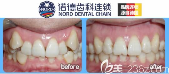 深圳诺德齿科成人隐适美虎牙矫正前后对比效果