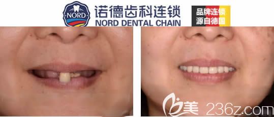 诺德口腔allon4种植牙真实案例
