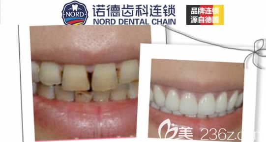 深圳诺德连锁全瓷牙修复前后对比照
