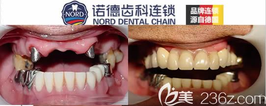 诺德齿科75岁老人戴精密附着体活动假牙对比效果