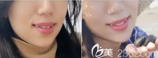 在深圳诺德齿科做牙齿矫正前的样子 在深圳诺德齿科做牙齿矫正前的样子