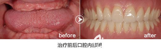 格伦菲尔口腔刘君主任全口种植牙案例 格伦菲尔口腔刘君主任全口种植牙案例