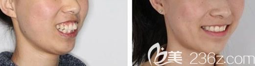 深圳格伦菲尔口腔刘君牙齿矫正案例 深圳格伦菲尔口腔刘君牙齿矫正案例