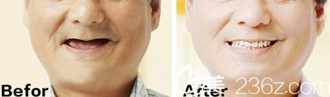 深圳格伦菲尔口腔种植牙案例 深圳格伦菲尔口腔种植牙案例