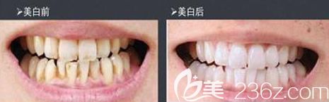 格伦菲尔口腔牙齿冷光美白效果 格伦菲尔口腔牙齿冷光美白效果