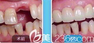 西安海涛口腔靠谱吗？海涛赵葛孟单颗牙既可种植案例效果公布