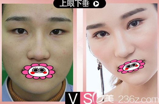 衡阳哪里割双眼皮好?看曹家整形双眼皮前后变化图 衡阳哪里割双眼皮好?看曹家整形双眼皮前后变化图