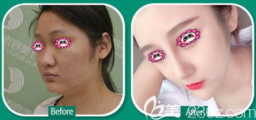 衡阳曹家整形怎么样?看曹新成医生隆鼻前后对比图 衡阳曹家整形怎么样?看曹新成医生隆鼻前后对比图