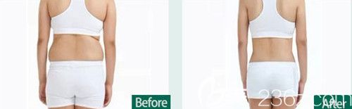 衡阳曹家整形好不好?看俞胜英医生吸脂效果图 衡阳曹家整形好不好?看俞胜英医生吸脂效果图