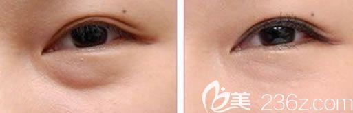 永康光大整形医院消除眼袋案例 永康光大整形医院消除眼袋案例