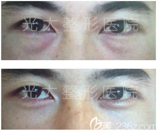 永康光大蒋建光去眼袋案例 永康光大蒋建光去眼袋案例