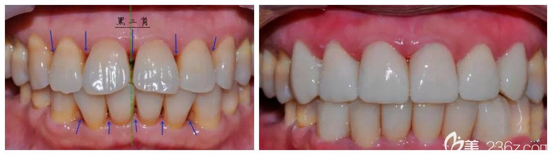 东红岗瓷睿刻牙齿修复案例