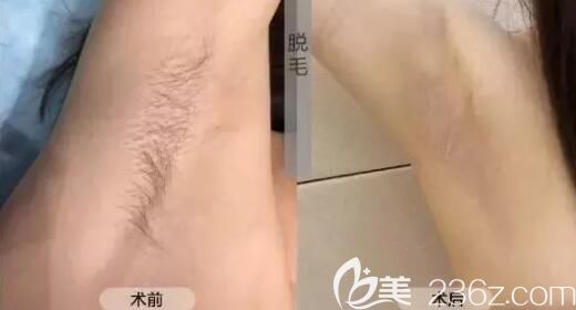 九江星瑞美脱毛案例