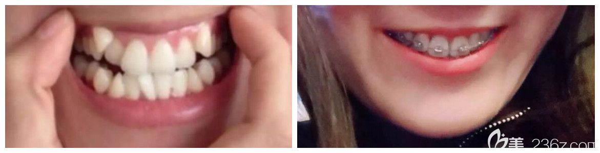 西安海涛口腔正畸怎么样?海涛冯雪牙齿矫正案例效果对比图公布 西安海涛口腔正畸怎么样?海涛冯雪牙齿矫正案例效果对比图公布