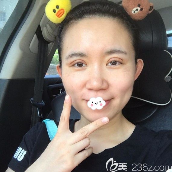 <!--<i data=20240703-sp></i>-->皮秒激光去斑术后真实恢复效果 <!--<i data=20240703-sp></i>-->皮秒激光去斑术后真实恢复效果