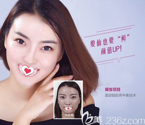 承德美天自体脂肪填充面部 承德美天自体脂肪填充面部