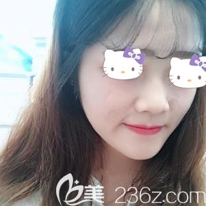 想变上镜小V脸到赣州亚韩医疗美容医院找吴礼诚主任做瘦脸除皱瘦脸后果然没让我失望