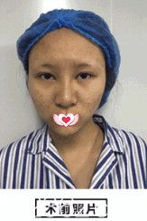 在邢台美加美做眼鼻综合术前是内双和塌鼻子 在邢台美加美做眼鼻综合术前是内双和塌鼻子