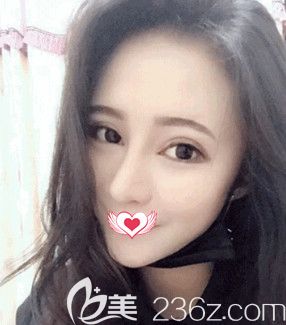 陈誉华院长做眼鼻综合整形术后10天已经消肿 陈誉华院长做眼鼻综合整形术后10天已经消肿