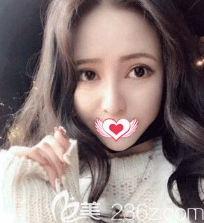 邢台美加美陈誉华院长做眼鼻综合术后25天恢复情况 邢台美加美陈誉华院长做眼鼻综合术后25天恢复情况